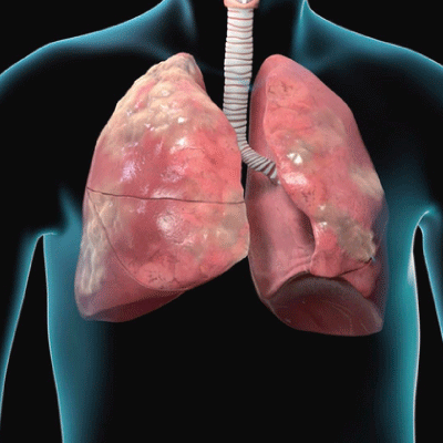 Apollo Homeopathy helps to cure for COPD