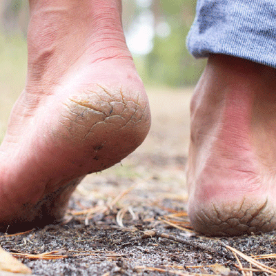 Apollo Homeopathy helps to cure for Cracked feet