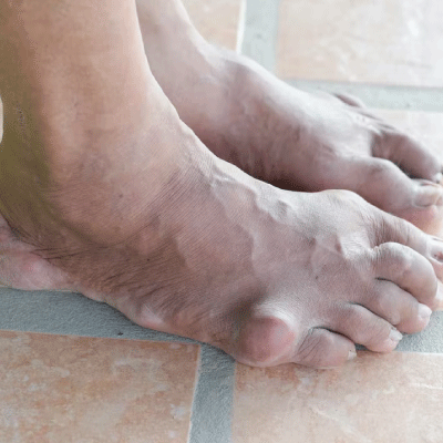 Apollo Homeopathy helps to cure for Gout
