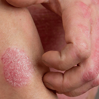 Apollo Homeopathy helps to cure for Psoriasis