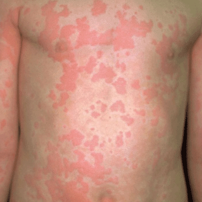 Apollo Homeopathy helps to cure for Urticaria